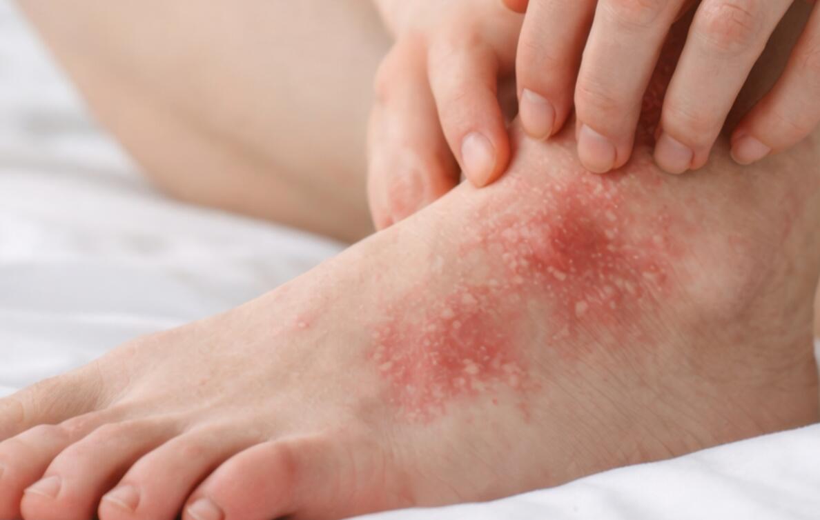 sintomi dell’eczema bolloso